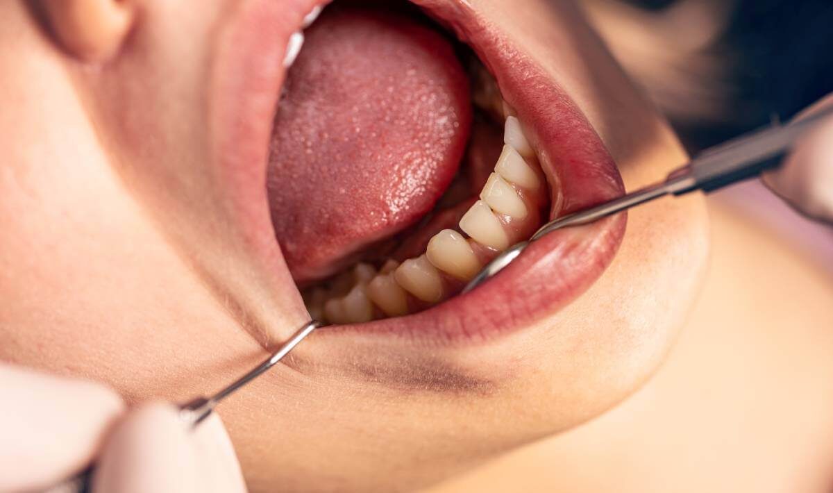 Nieprawidłowe pH jamy ustnej może mieć szkodliwy wpływ na stan uzębienia